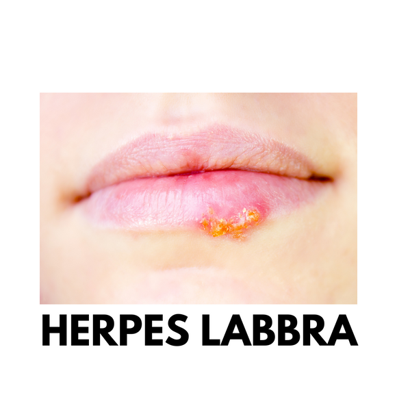 Herpes e Labbra