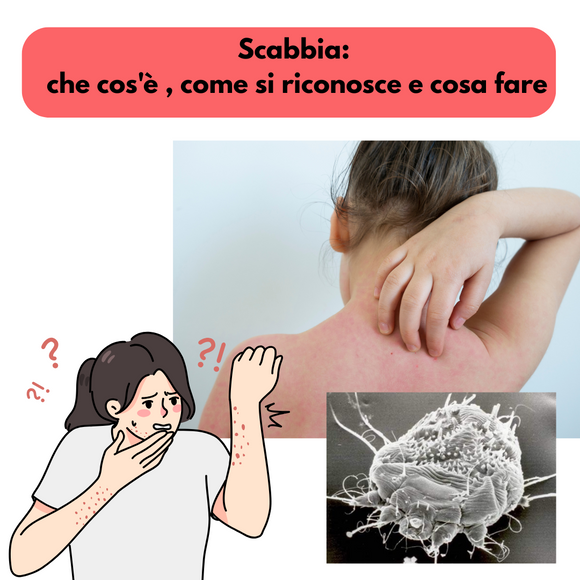 Scabbia: che cos'è , come si riconosce e cosa fare